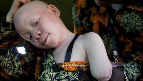 African albinos killed for body organs